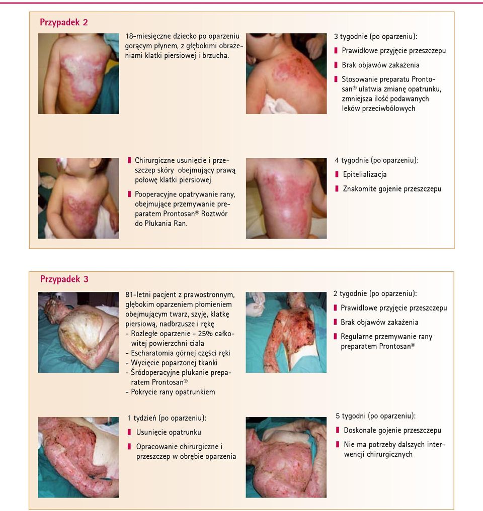 Chirurgiczne usunięcie i przeszczep skóry obejmujący prawą połowę klatki piersiowej Pooperacyjne opatrywanie rany, obejmujące przemywanie preparatem Prontosan Roztwór do Płukania Ran.