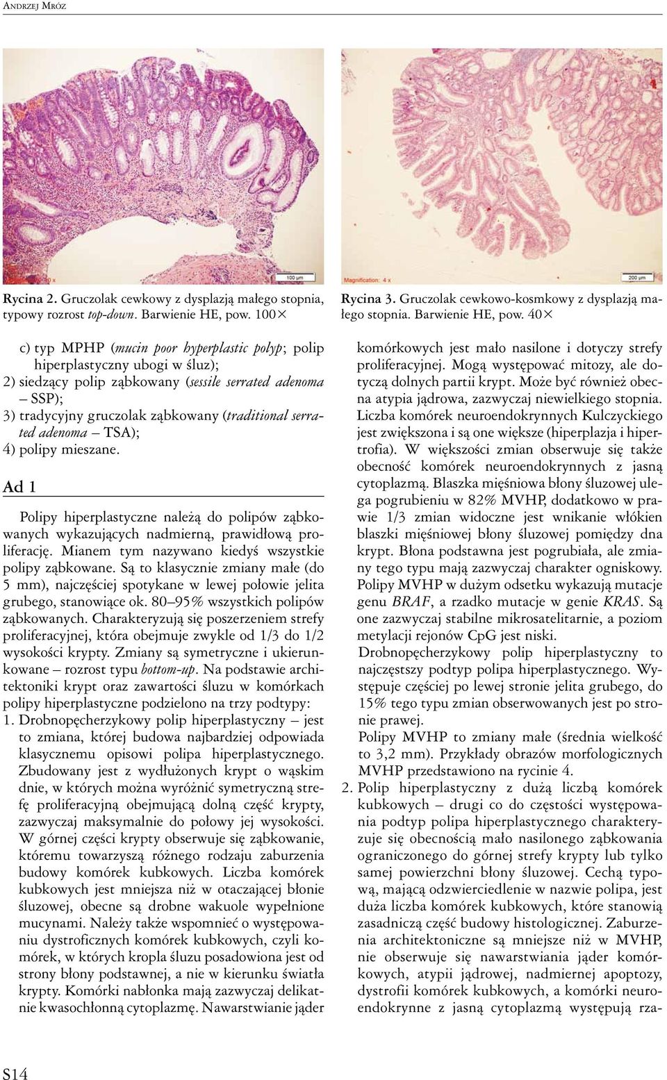serrated adenoma TSA); 4) polipy mieszane. Ad 1 Polipy hiperplastyczne należą do polipów ząbkowanych wykazujących nadmierną, prawidłową proliferację.