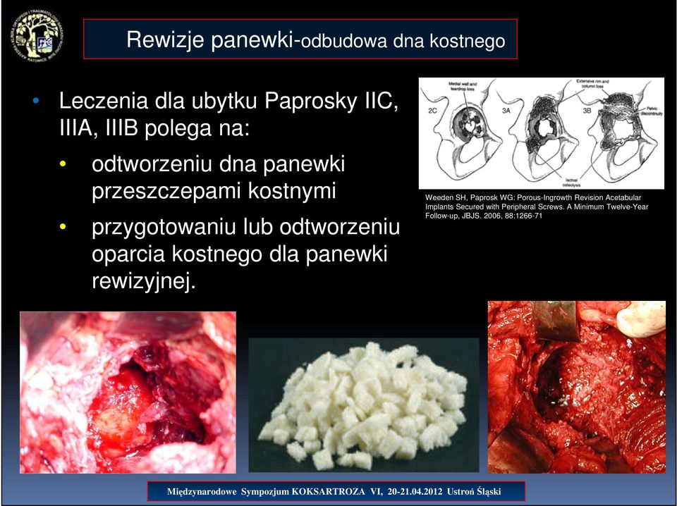 kostnego dla panewki rewizyjnej.