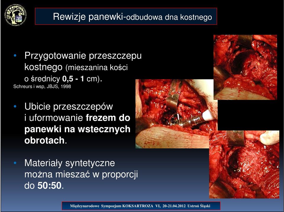 Schreurs i wsp, JBJS, 1998 Ubicie przeszczepów i uformowanie frezem