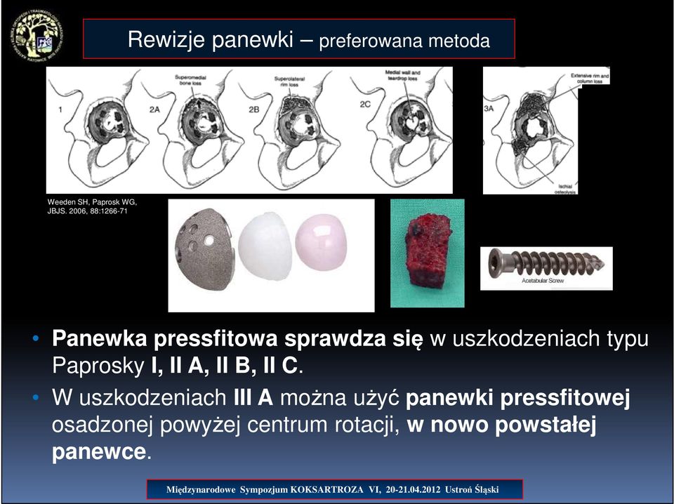 typu Paprosky I, II A, II B, II C.