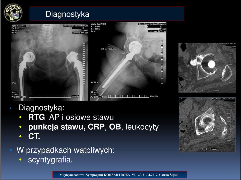 stawu, CRP, OB, leukocyty CT.