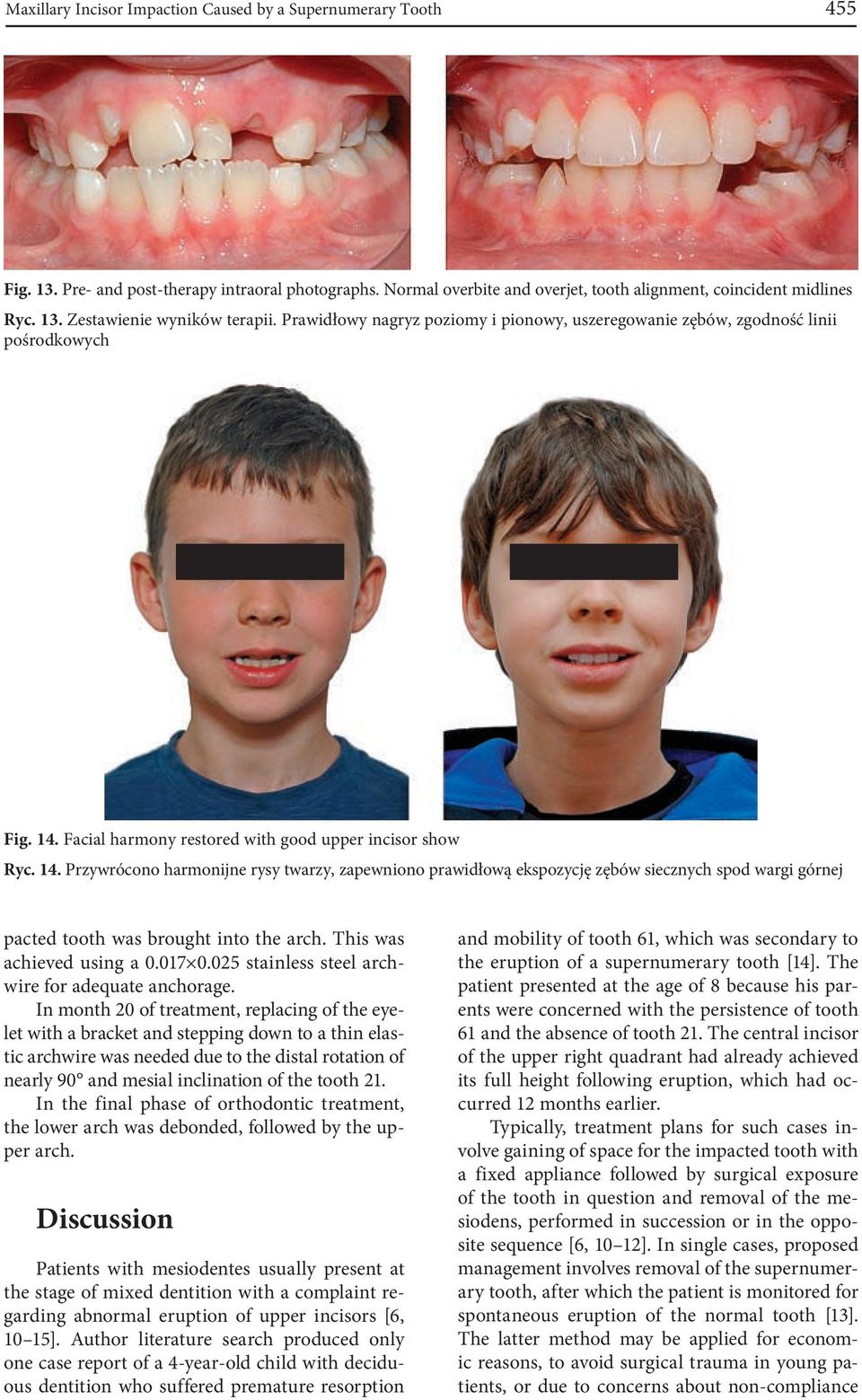Facial harmony restored with good upper incisor show Ryc. 14.