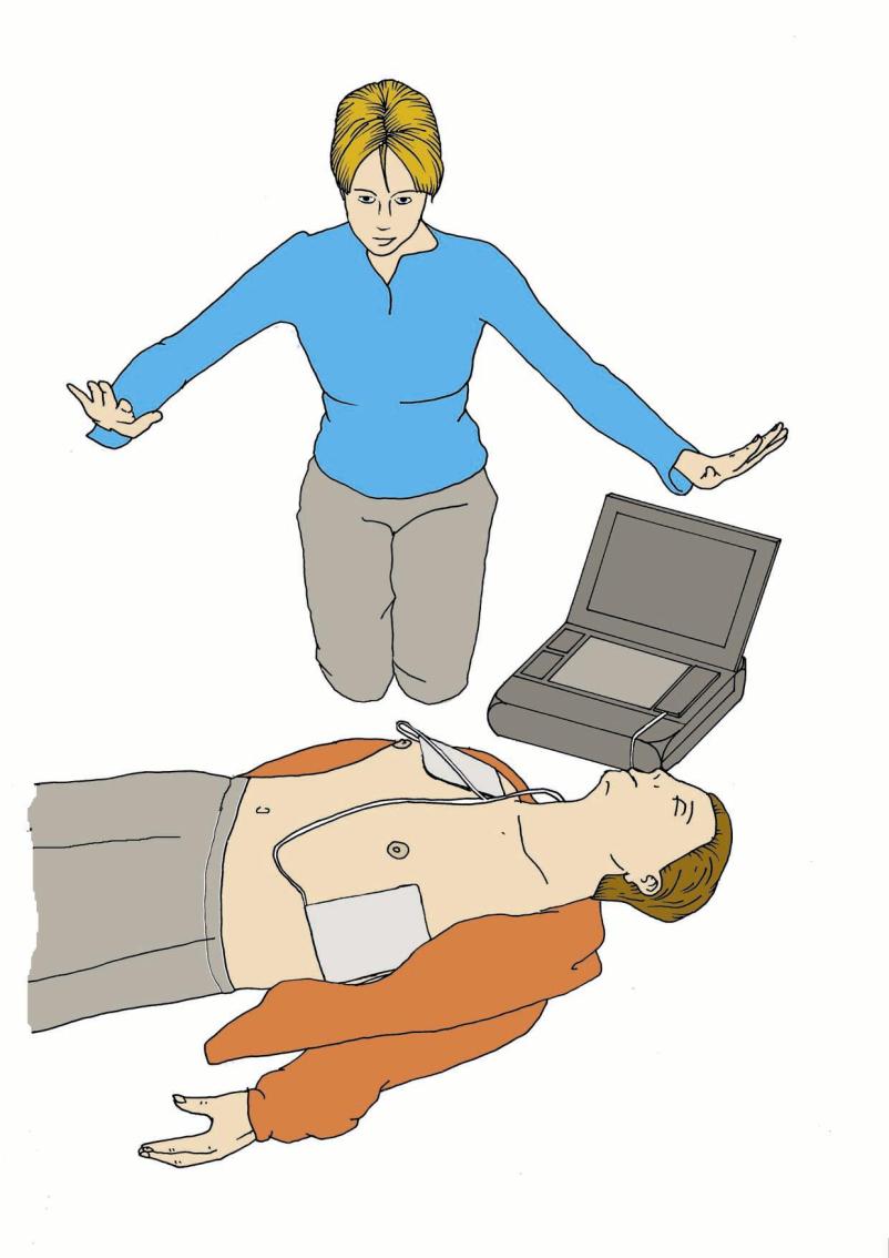 AED (Automated External Defibrillator) Sam rozpoznaje mechanizm zatrzymania krążenia Sam decyduje o
