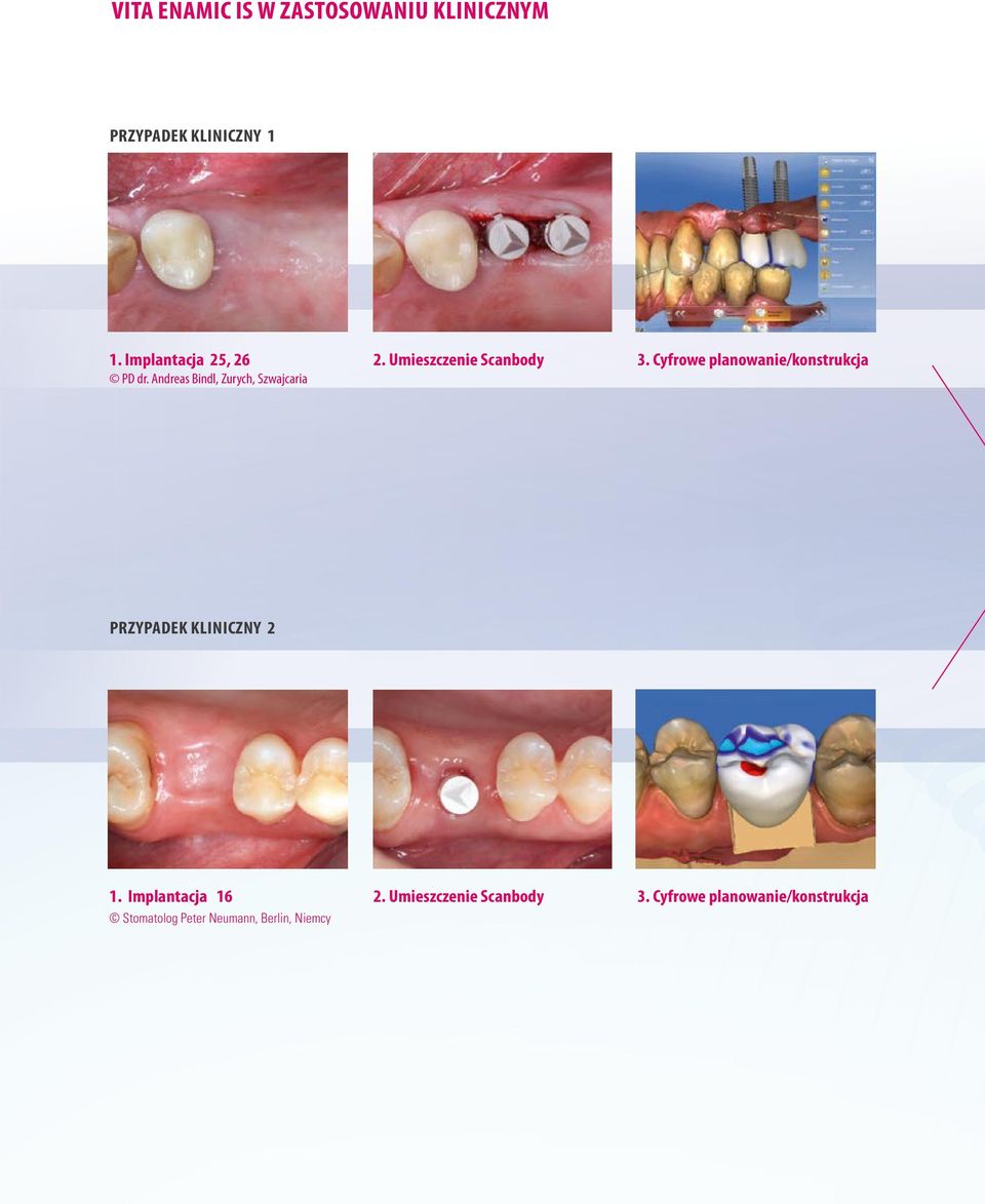 Umieszczenie Scanbody 3. Cyfrowe planowanie/konstrukcja PRZYPADEK KLINICZNY 2 1.