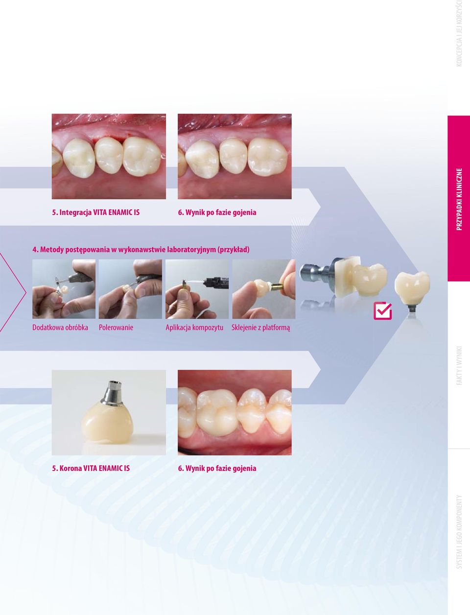 Polerowanie Aplikacja kompozytu Sklejenie z platformą 5. Korona VITA ENAMIC IS 6.
