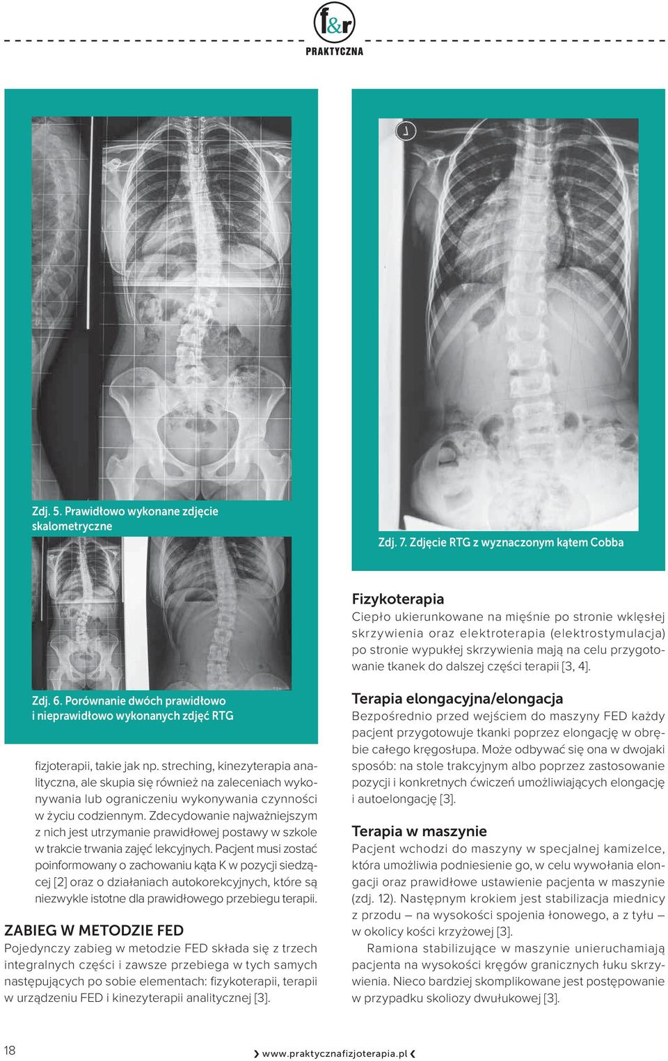 tkank do dalszj części trapii [3, 4]. Zdj. 6. Porównani dwóch prawidłowo i niprawidłowo wykonanych zdjęć RTG fizjotrapii, taki jak np.