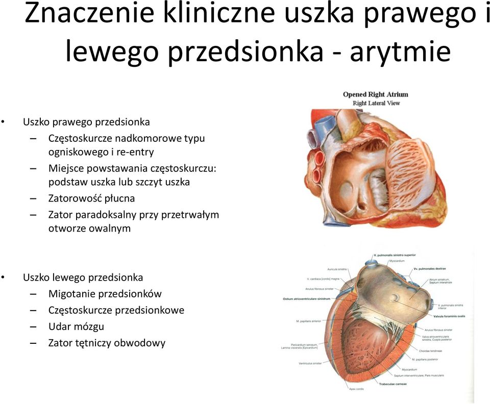 uszka lub szczyt uszka Zatorowość płucna Zator paradoksalny przy przetrwałym otworze owalnym