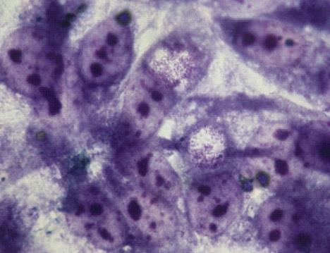 Chlamydia