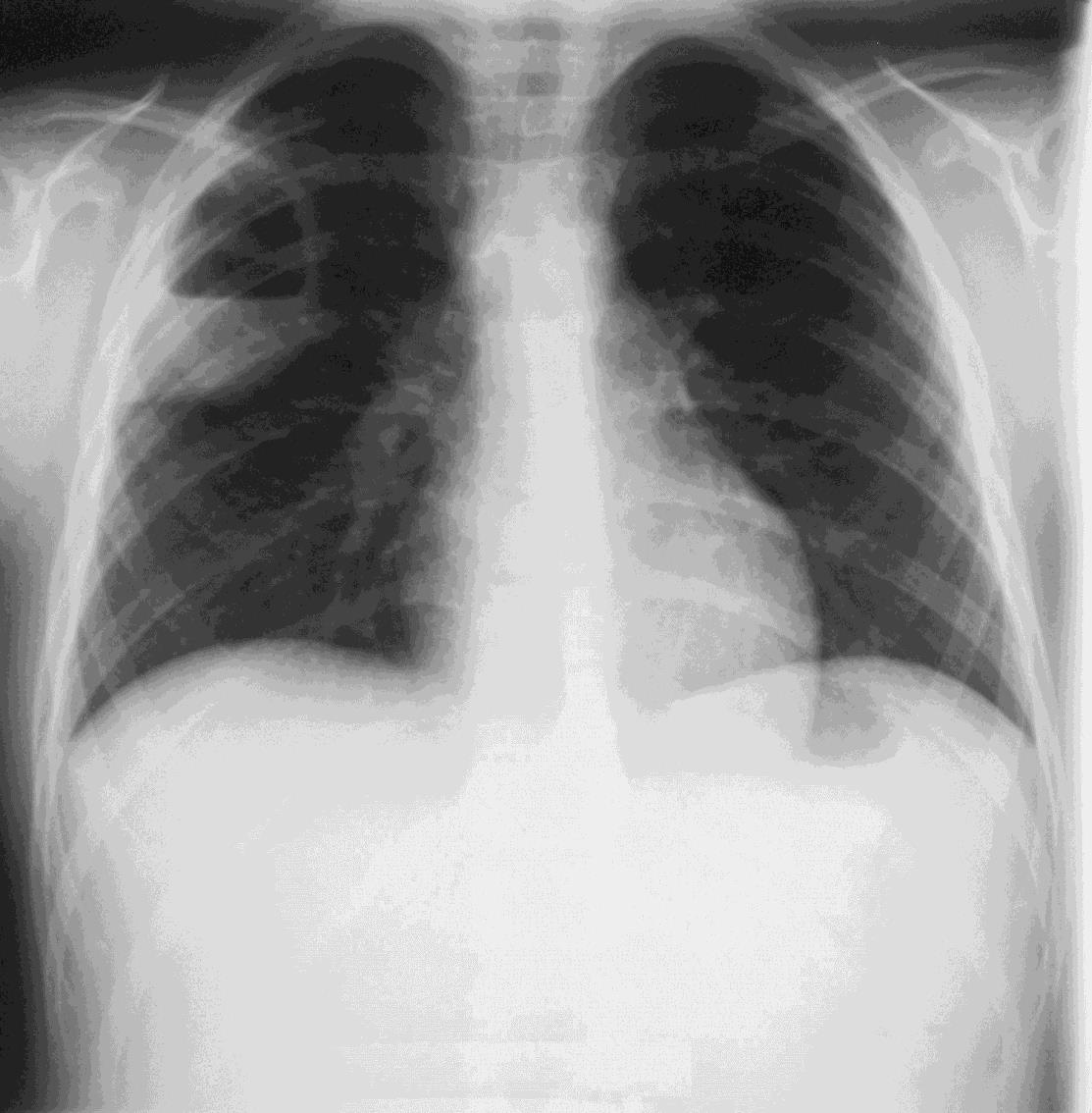 Ropień płuca Antybiotykoterapia 2-3 tygodni i.v.