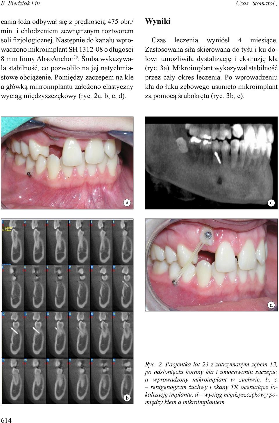 Pomiędzy zaczepem na kle a główką mikroimplantu założono elastyczny wyciąg międzyszczękowy (ryc. 2a, b, c, d). Wyniki Czas leczenia wyniósł 4 miesiące.