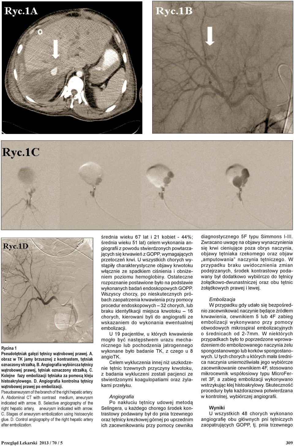 Angiografia kontrolna tętnicy wątrobowej prawej po embolizacji. Pseudoaneurysm of the branch of the right hepatic artery. A. Abdominal CT with contrast medium, aneurysm indicated with arrow. B.