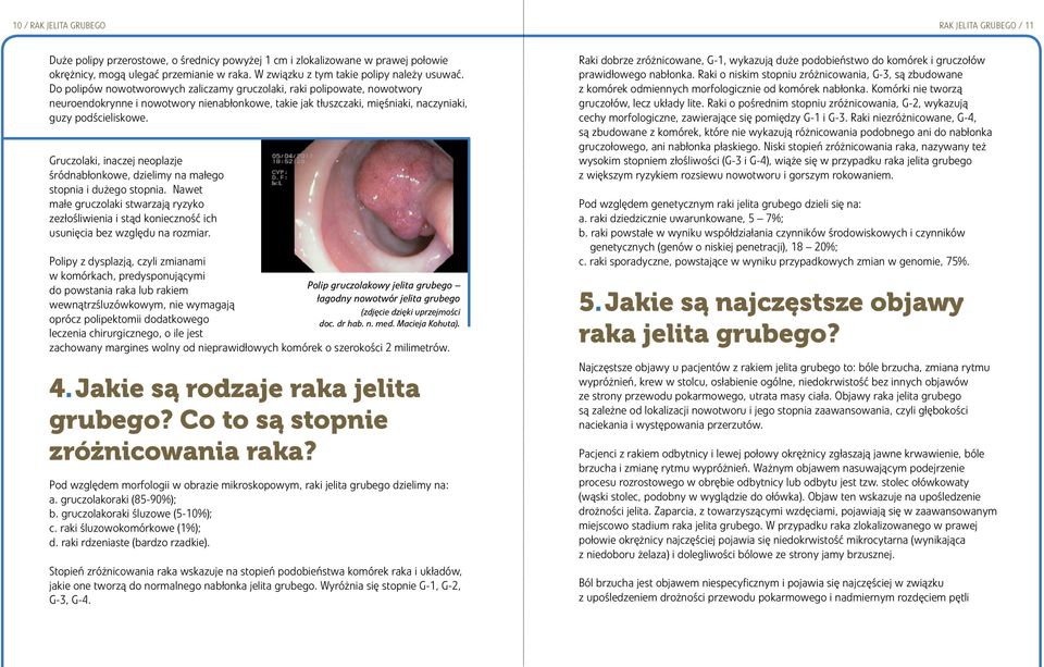 Do polipów nowotworowych zaliczamy gruczolaki, raki polipowate, nowotwory neuroendokrynne i nowotwory nienabłonkowe, takie jak tłuszczaki, mięśniaki, naczyniaki, guzy podścieliskowe.