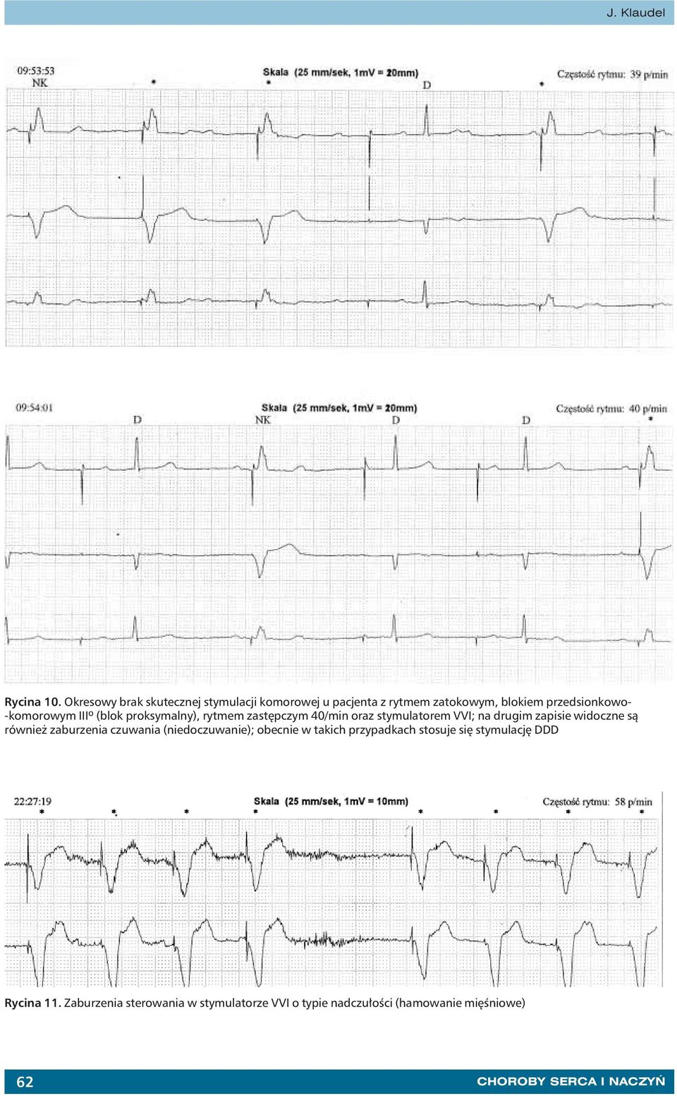 o (blok proksymalny), rytmem zastępczym 40/min oraz stymulatorem VVI; na drugim zapisie widoczne są również