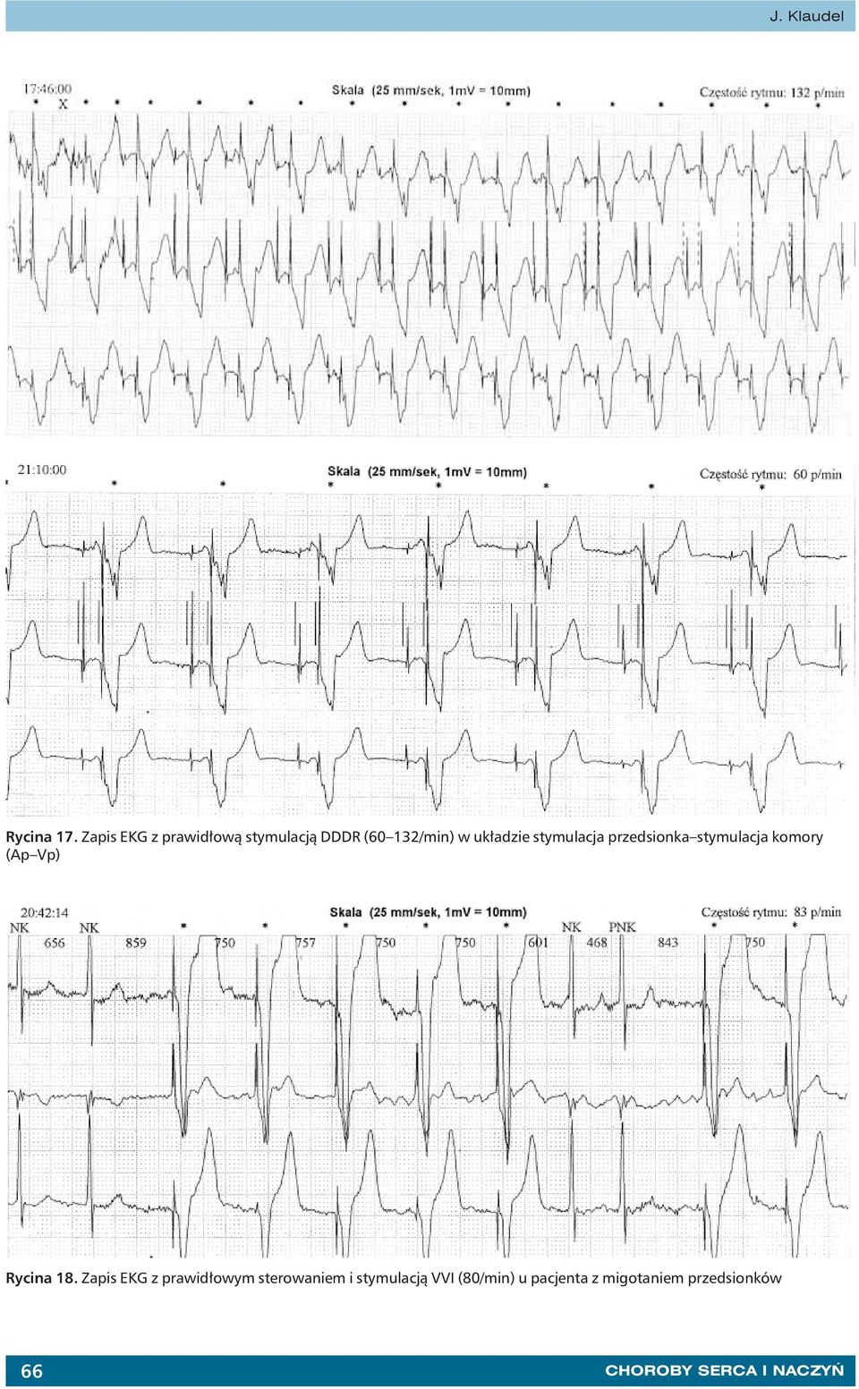 stymulacja przedsionka stymulacja komory (Ap Vp) Rycina 18.