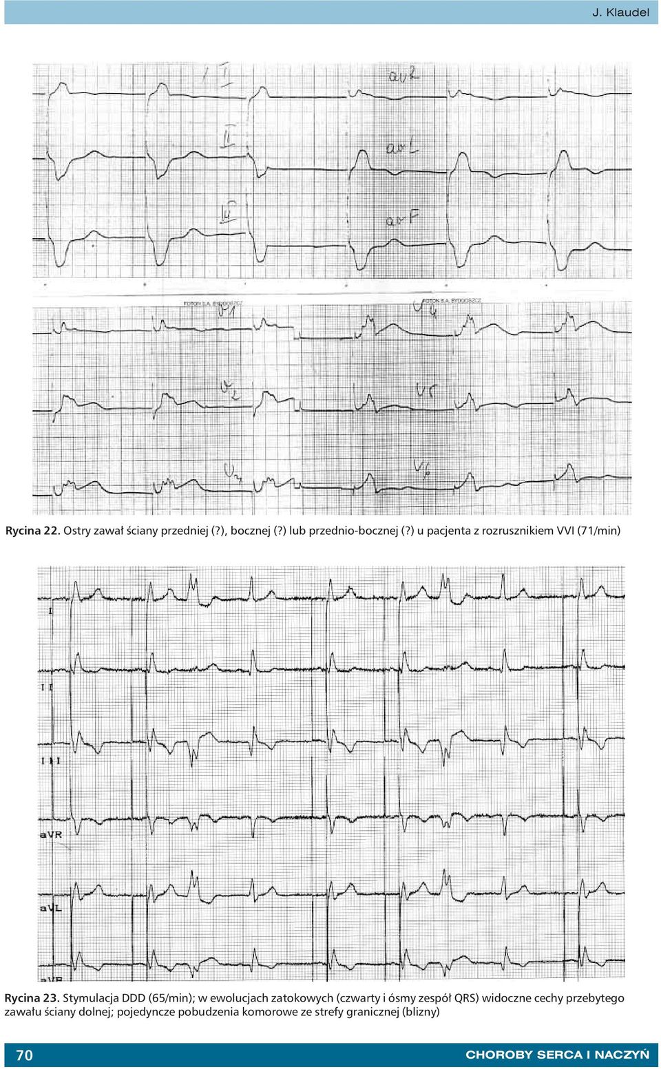 Stymulacja DDD (65/min); w ewolucjach zatokowych (czwarty i ósmy zespół QRS) widoczne