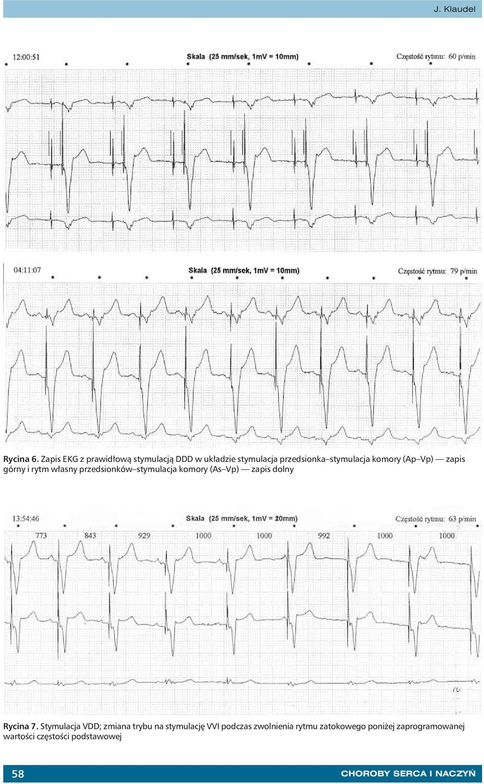 (Ap Vp) zapis górny i rytm własny przedsionków stymulacja komory (As Vp) zapis dolny Rycina