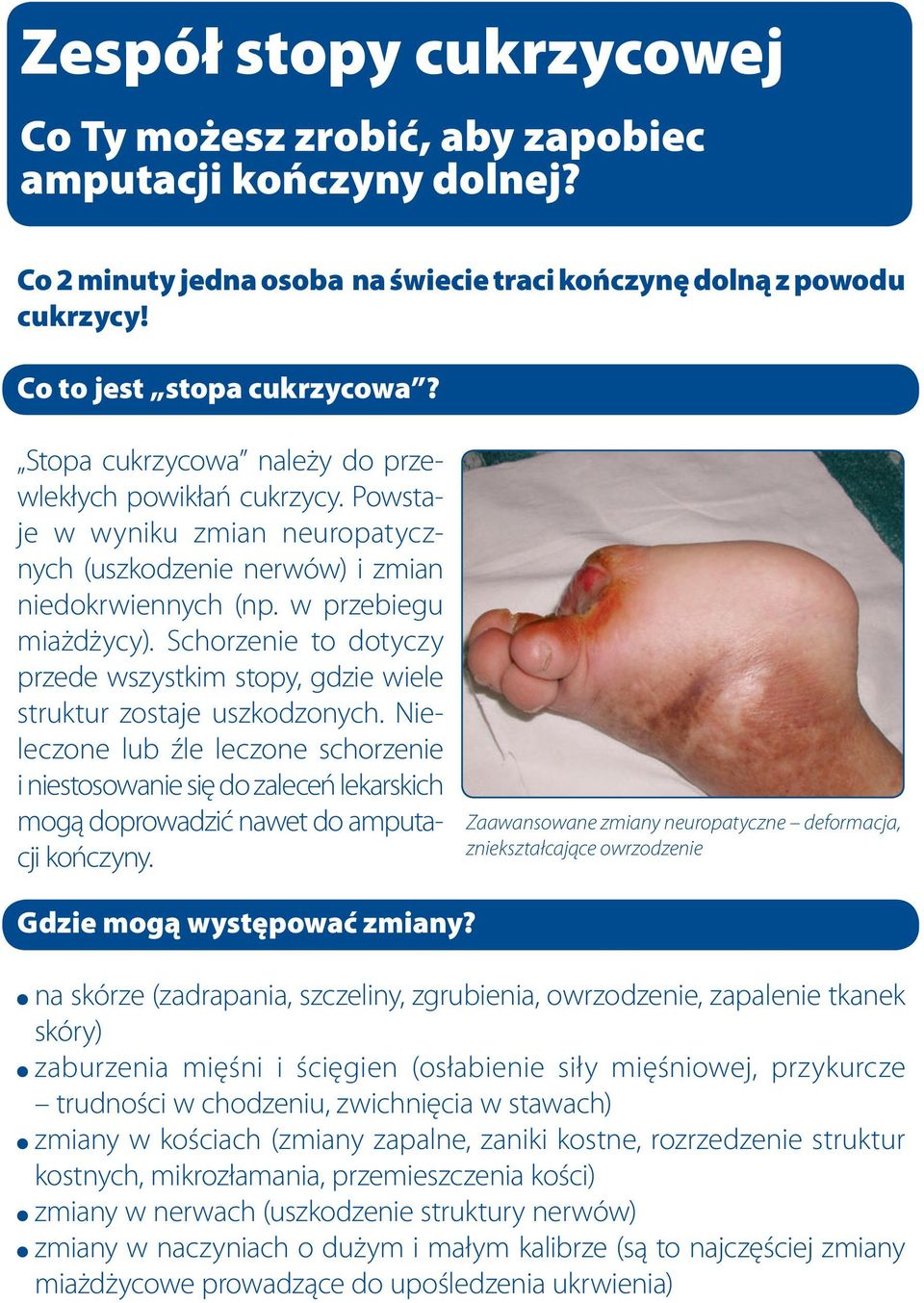 Schorzenie to dotyczy przede wszystkim stopy, gdzie wiele struktur zostaje uszkodzonych.