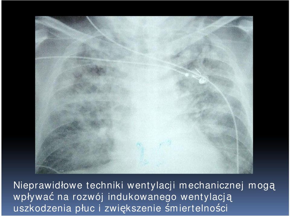 rozwój indukowanego wentylacją