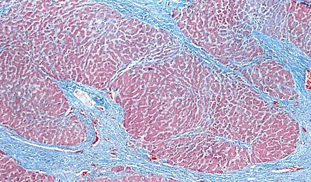 Stany patologiczne Choroby spichrzeniowe nadmierne gromadzenie żelaza i miedzi Wrodzona hemochromacytoza wzrost absorpcji żelaza i jego akumulacja w lizosomach hepatocytów (powikłania: marskość, rak