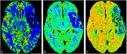 Perfuzja MR (PWI) Ocena przepływu tkankowego - przejścia CM przez łożysko naczyniowe (od wpustu tętniczego do odpływu żylnego) Parametry Cerebral blood