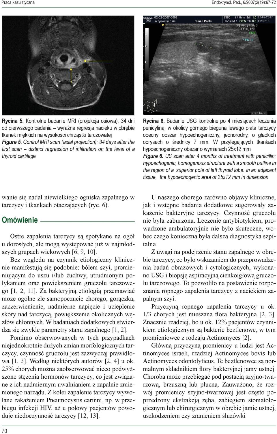Control MRI scan (axial projection): 34 days after the first scan distinct regression of infiltration on the level of a thyroid cartilage Rycina 6.