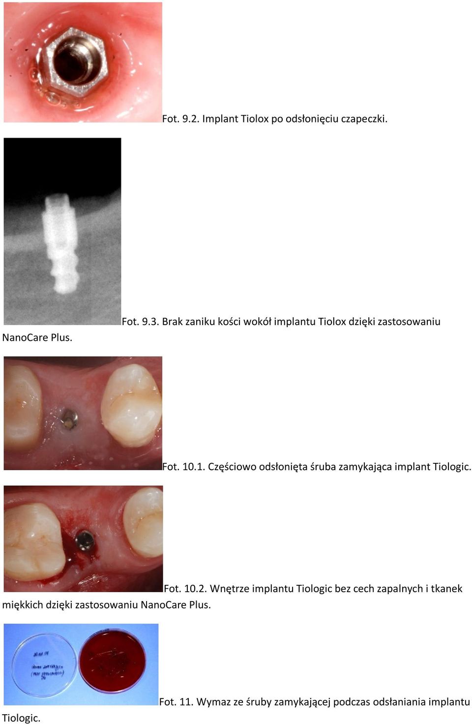 .1. Częściowo odsłonięta śruba zamykająca implant Tiologic. Fot. 10.2.