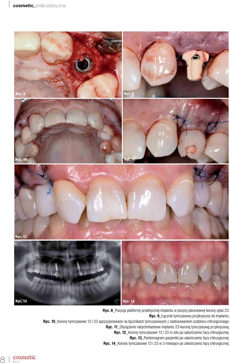 11_Obciążenie natychmiastowe implantu 23 koroną tymczasową przykręcaną. Ryc. 12_Korony tymczasowe 13 i 23 in situ po zakończeniu fazy chirurgicznej. Ryc. 13_Pantomogram pacjentki po zakończeniu fazy chirurgicznej.