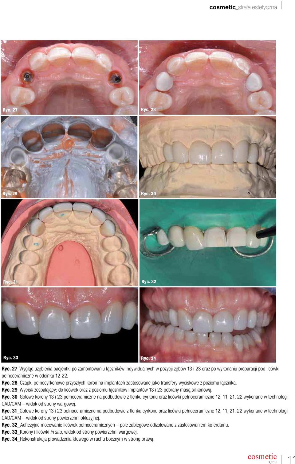 28_Czapki pełnocyrkonowe przyszłych koron na implantach zastosowane jako transfery wyciskowe z poziomu łącznika. Ryc.