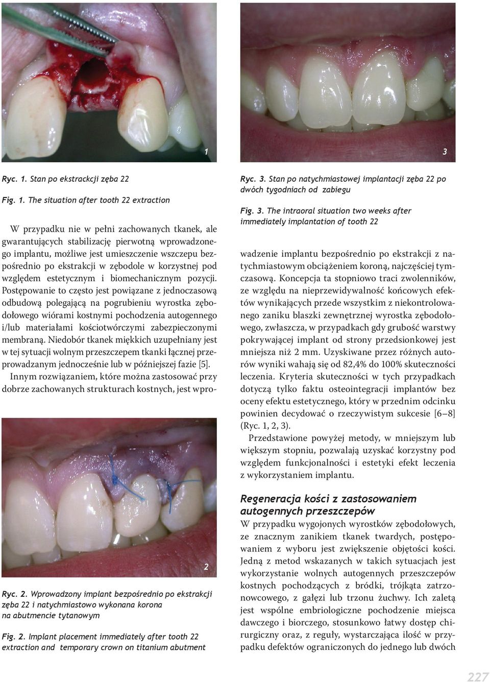 Stan po natychmiastowej implantacji zęba 22 po dwóch tygodniach od zabiegu Fig. 3.