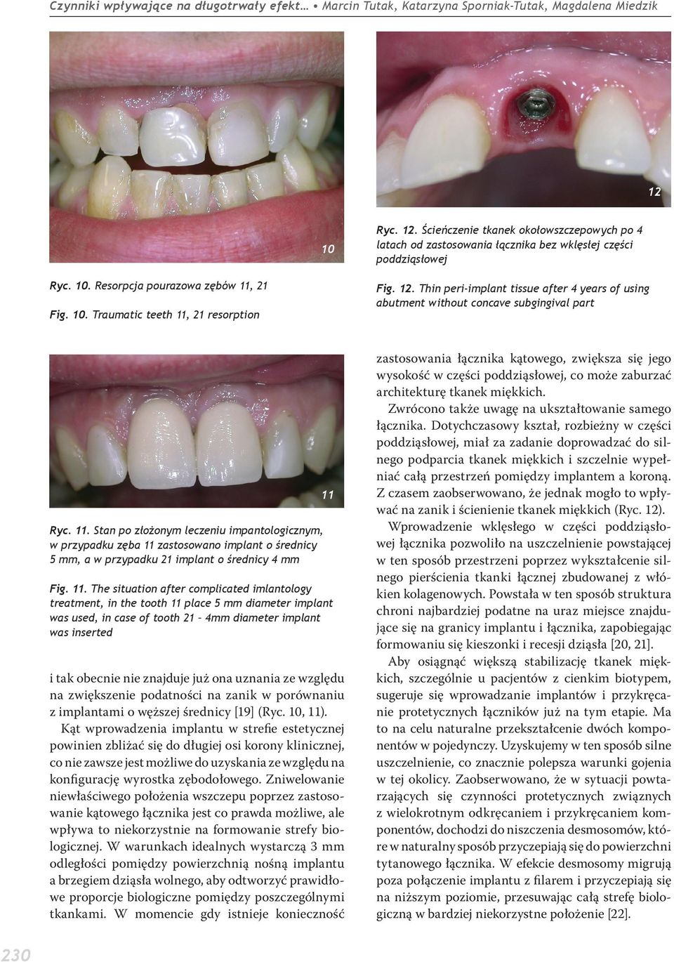 12. Thin peri-implant tissue after 4 years of using abutment without concave subgingival part Ryc. 11.