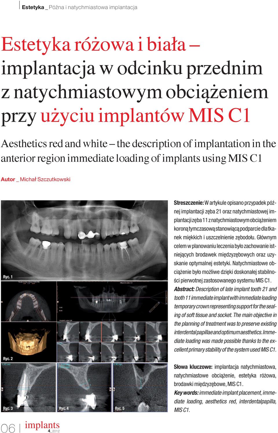 5 Streszczenie: W artykule opisano przypadek póênej implantacji z ba 21 oraz natychmiastowej implantacji z ba 11 z natychmiastowym obcià eniem koronà tymczasowà stanowiàcà podparcie dla tkanek mi