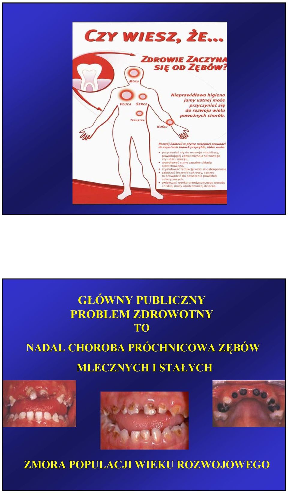 PRÓCHNICOWA ZĘBÓW MLECZNYCH I