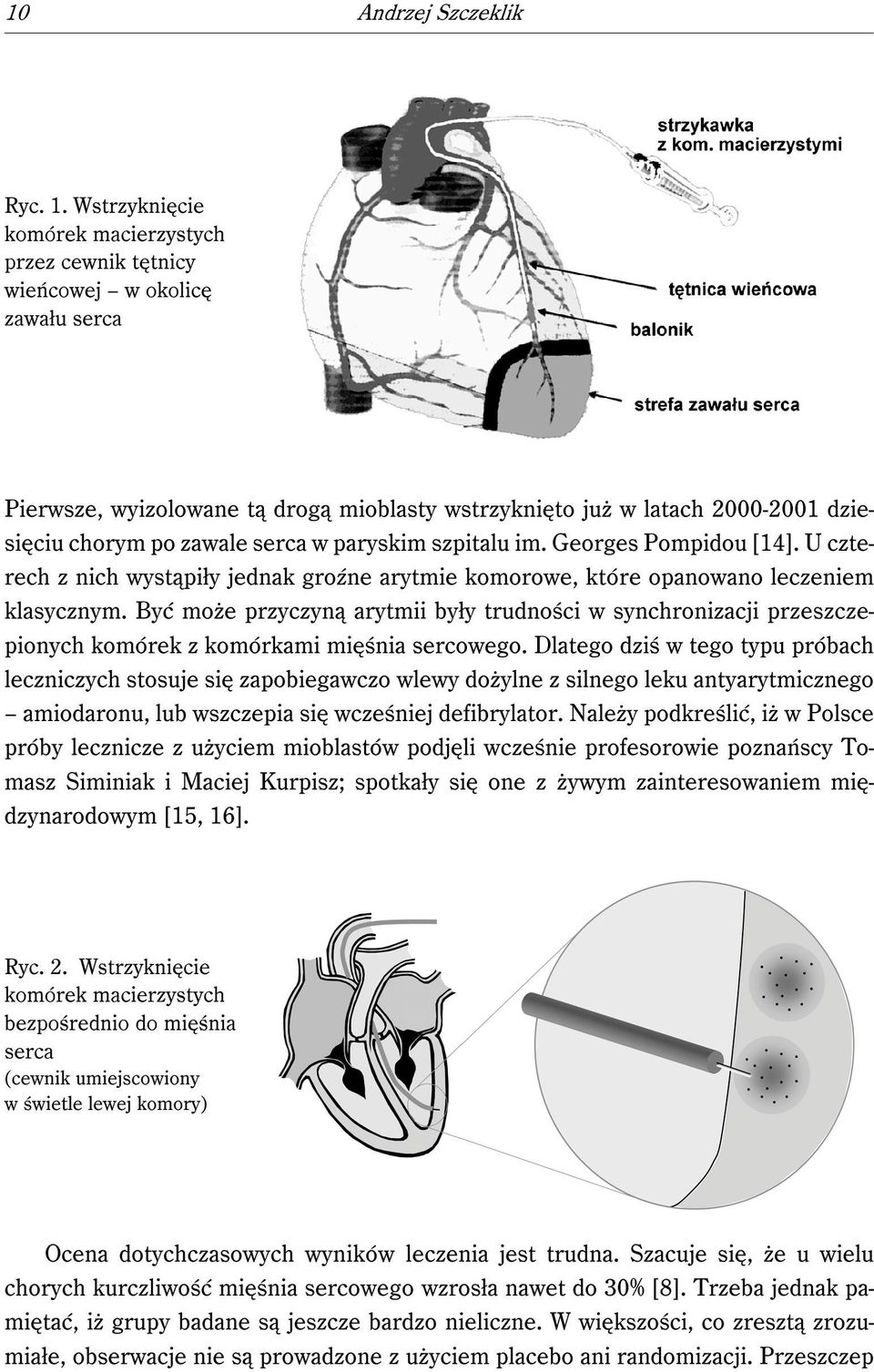 serca w paryskim szpitalu im. Georges Pompidou [14]. U czterech z nich wystąpiły jednak groźne arytmie komorowe, które opanowano leczeniem klasycznym.