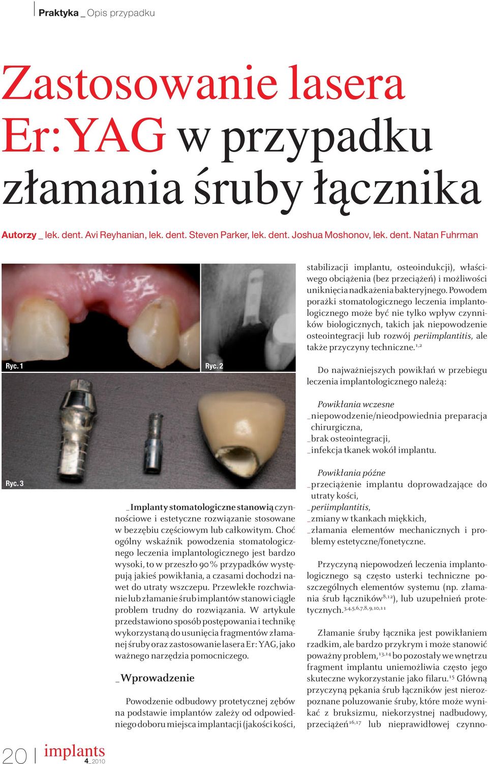 Powodem porażki stomatologicznego leczenia implantologicznego może być nie tylko wpływ czynników biologicznych, takich jak niepowodzenie osteointegracji lub rozwój periimplantitis, ale także