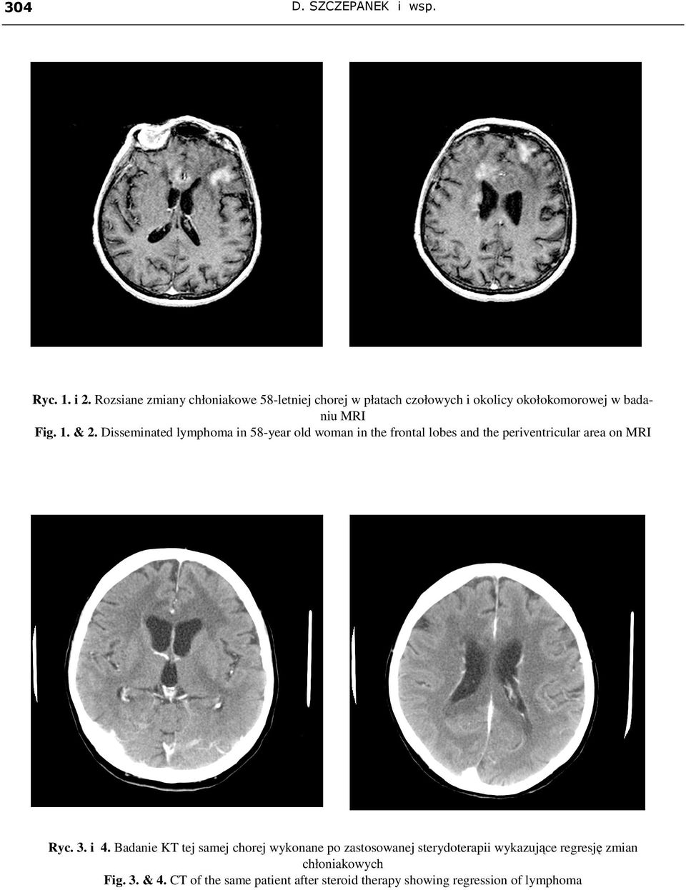 Disseminated lymphoma in 58-year old woman in the frontal lobes and the periventricular area on MRI Ryc. 3. i 4.