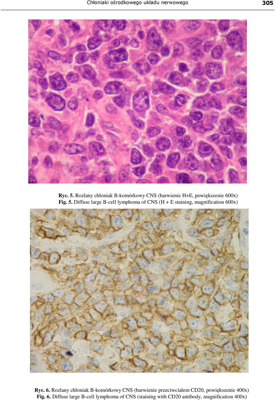 Diffuse large B-cell lymphoma of CNS (H + E staining, magnification 60