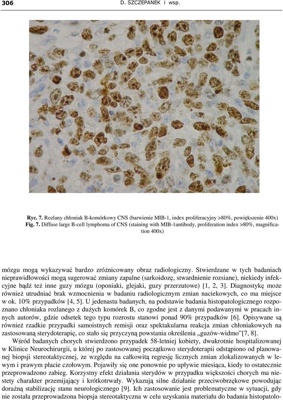 Diffuse large B-cell lymphoma of CNS (staining with MIB-1antibody, proliferation index >80%, magnification 400x) mózgu mogą wykazywać bardzo zróŝnicowany obraz radiologiczny.