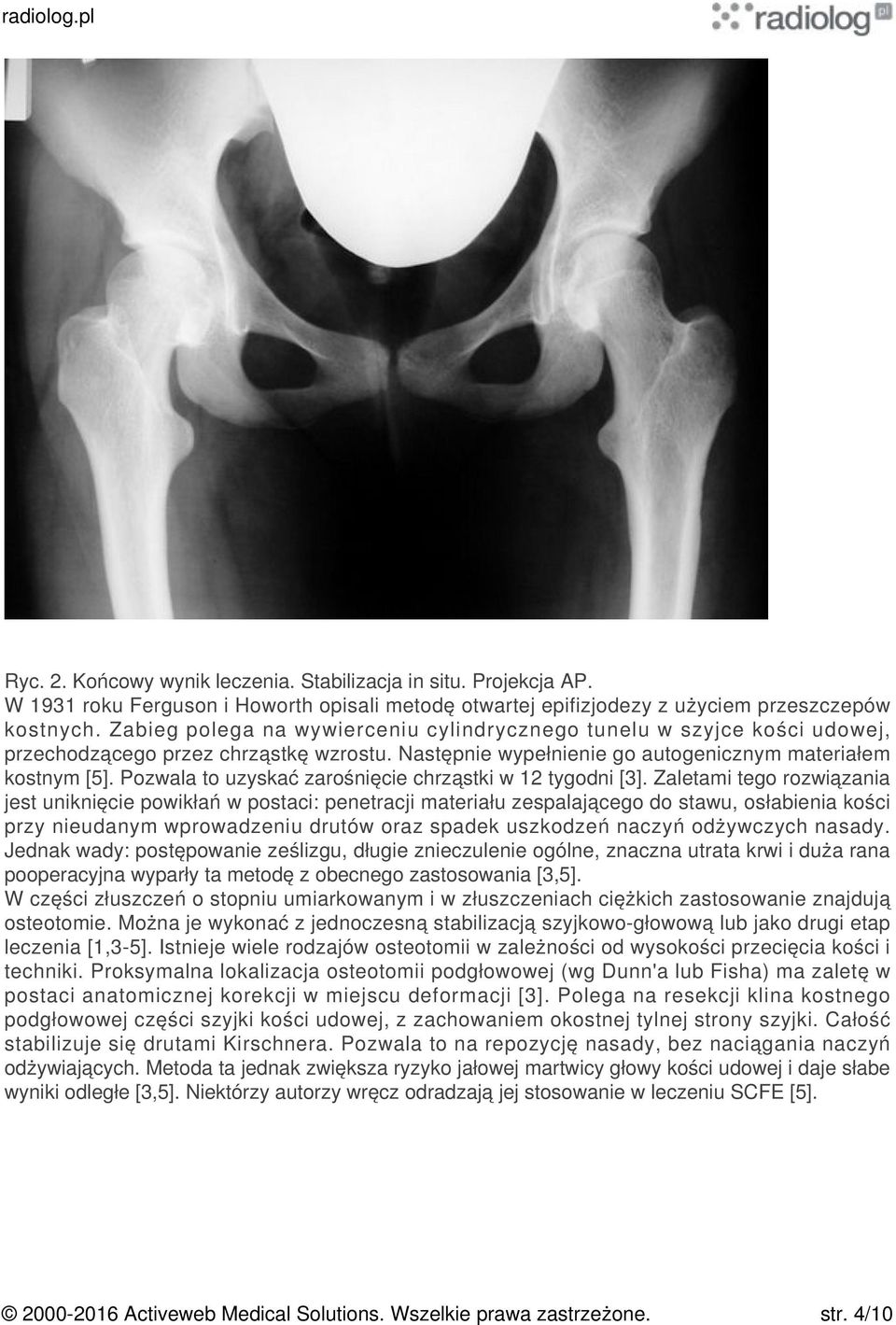 Pozwala to uzyskać zarośnięcie chrząstki w 12 tygodni [3].