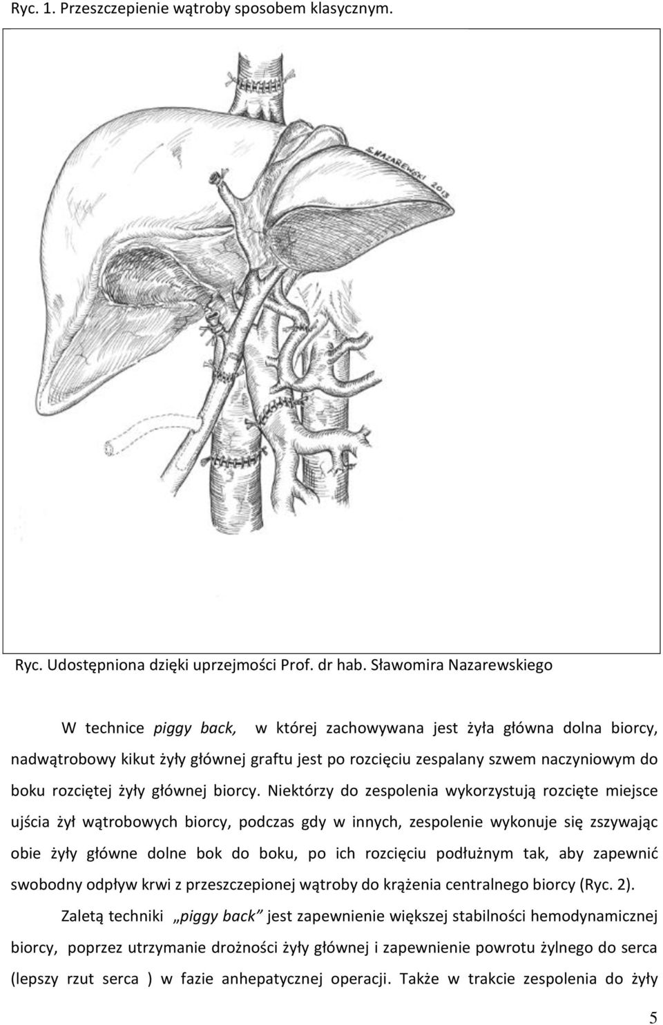 rozciętej żyły głównej biorcy.