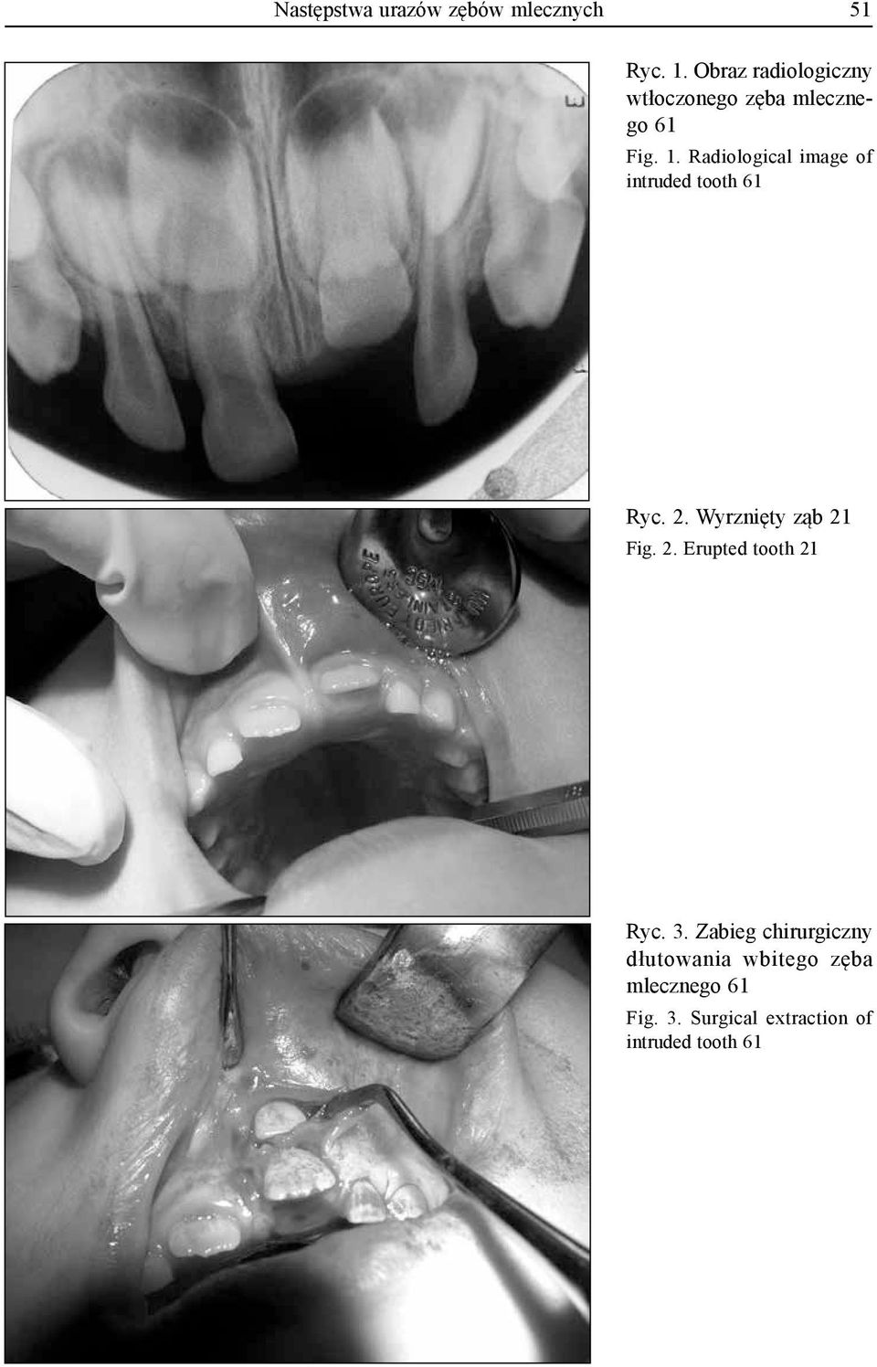 Radiological image of intruded tooth 61 Ryc. 2. Wyrznięty ząb 21 Fig. 2. Erupted tooth 21 Ryc.
