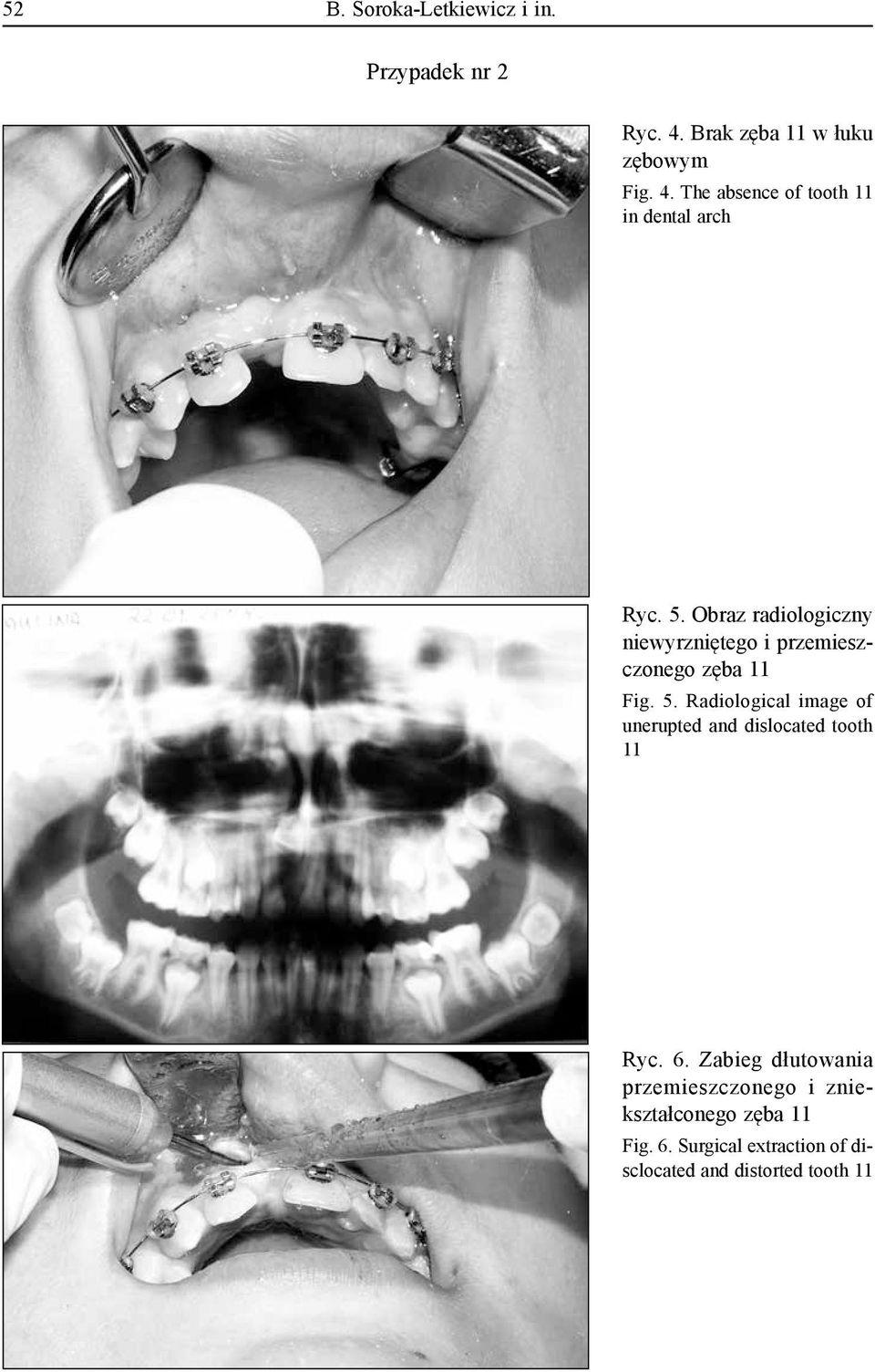 Radiological image of unerupted and dislocated tooth 11 Ryc. 6.