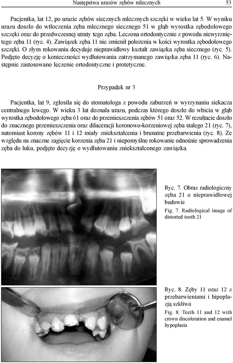 Leczona ortodontycznie z powodu niewyrzniętego zęba 11 (ryc. 4). Zawiązek zęba 11 nie zmienił położenia w kości wyrostka zębodołowego szczęki.