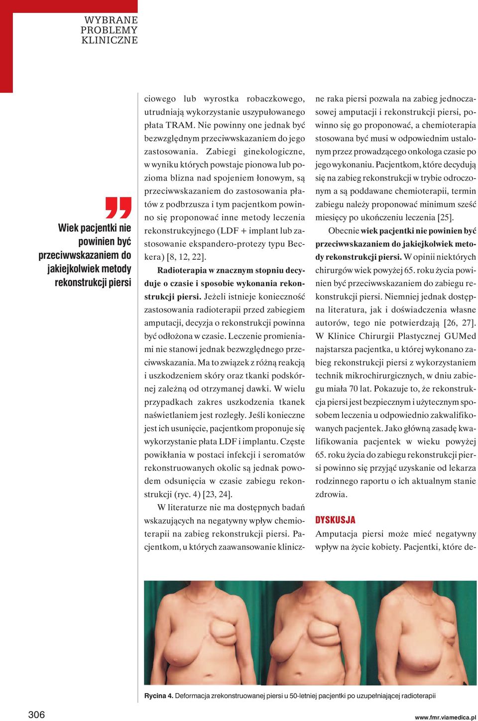 Zabiegi ginekologiczne, w wyniku których powstaje pionowa lub pozioma blizna nad spojeniem łonowym, są przeciwwskazaniem do zastosowania płatów z podbrzusza i tym pacjentkom powinno się proponować
