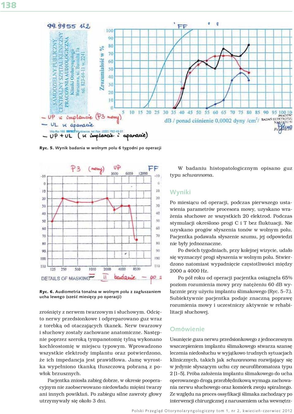 Następnie poprzez szeroką tympanotomię tylną wykonano kochleostomię w miejscu typowym. Wprowadzono wszystkie elektrody implantu oraz potwierdzono, że ich impedancja jest prawidłowa.