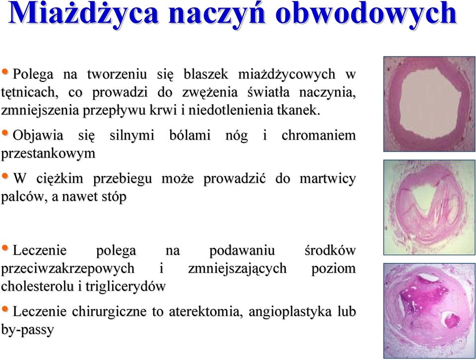 Objawia się silnymi bólami nóg i chromaniem przestankowym W ciężkim przebiegu może prowadzić do martwicy palców, a nawet