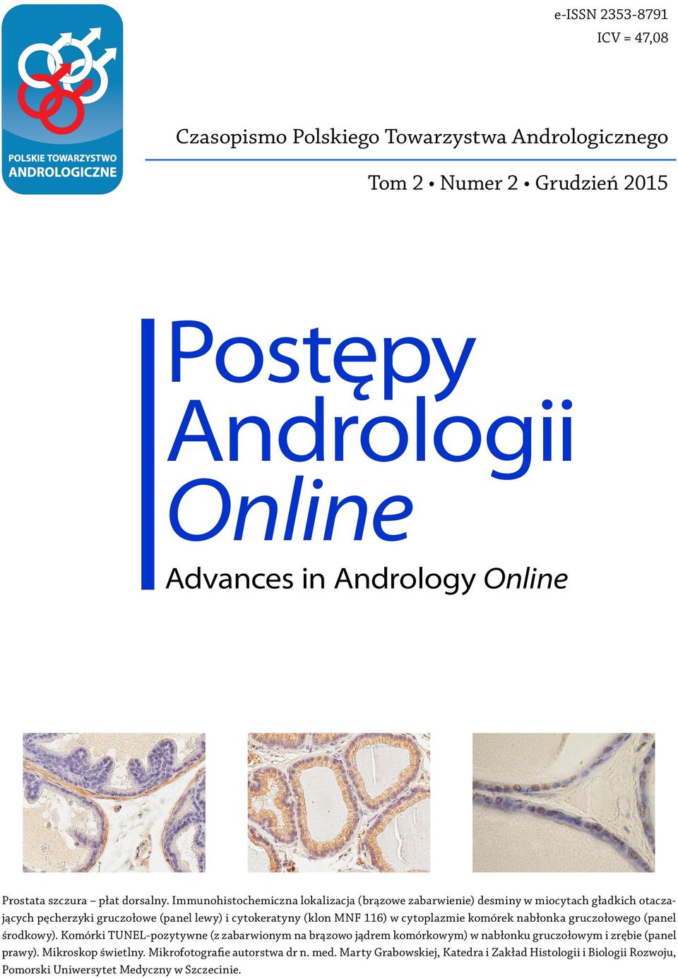 Immunohistochemiczna lokalizacja (brązowe zabarwienie) desminy w miocytach gładkich otaczających pęcherzyki gruczołowe (panel lewy) i cytokeratyny (klon MNF 116) w