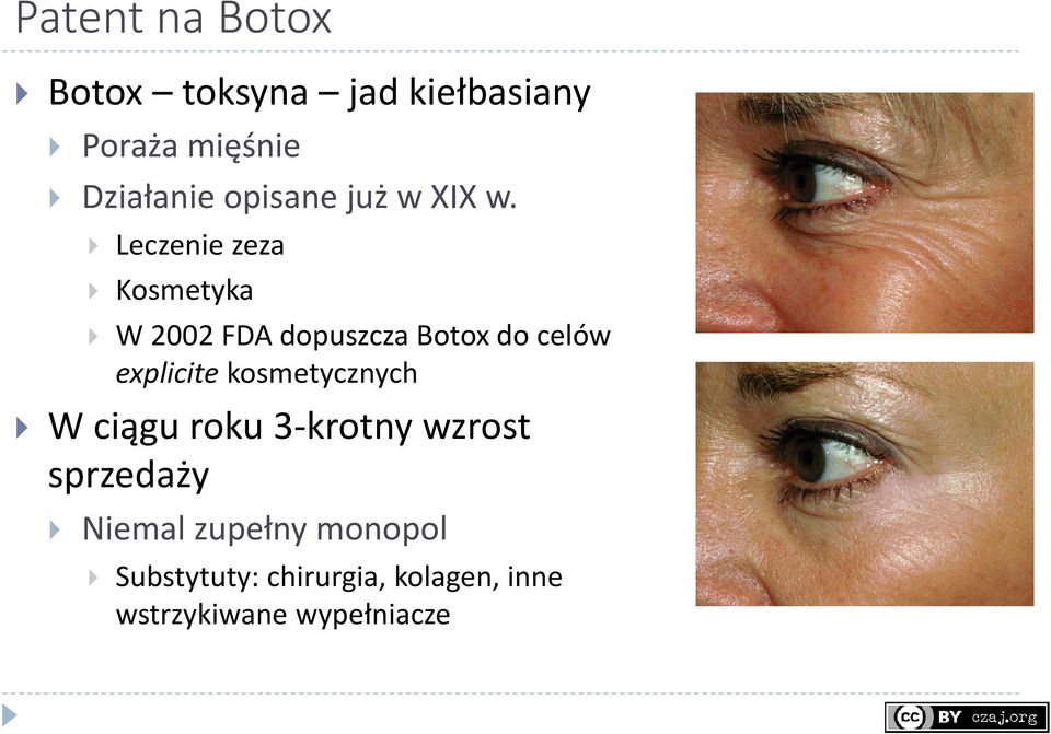 Leczenie zeza Kosmetyka W 2002 FDA dopuszcza Botox do celów explicite