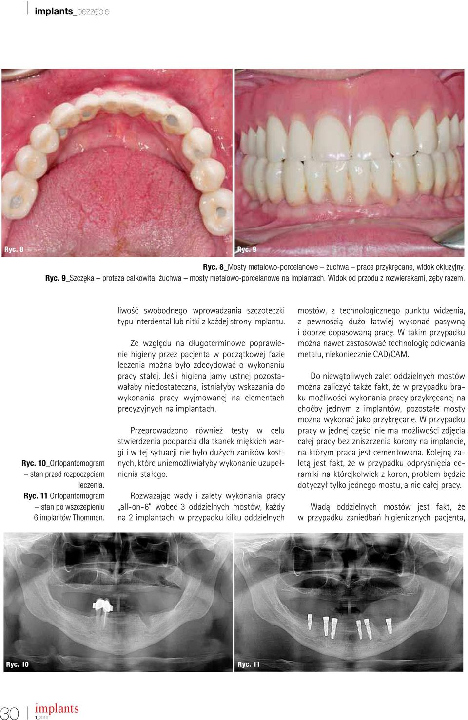 liwość swobodnego wprowadzania szczoteczki typu interdental lub nitki z każdej strony implantu.