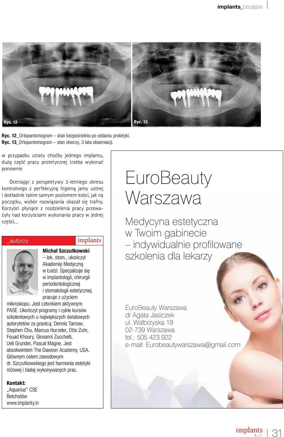 Oceniając z perspektywy 3-letniego okresu kontrolnego z perfekcyjną higieną jamy ustnej i dokładnie takim samym poziomem kości, jak na początku, wybór rozwiązania okazał się trafny.